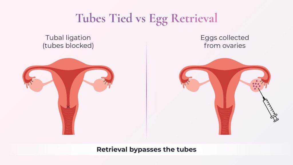 Side-by-side diagram: tubal ligation blocks tubes; egg retrieval accesses the ovaries directly